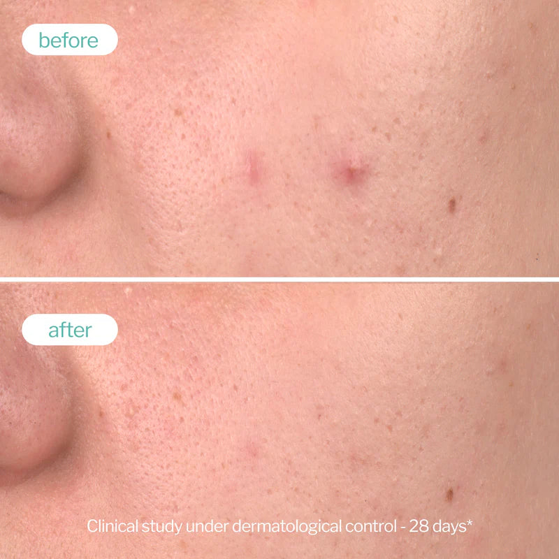 Novexpert Clear Skin piling serum – Dupla obnova za čist ten, manje nesavršenosti i anti-age efekat