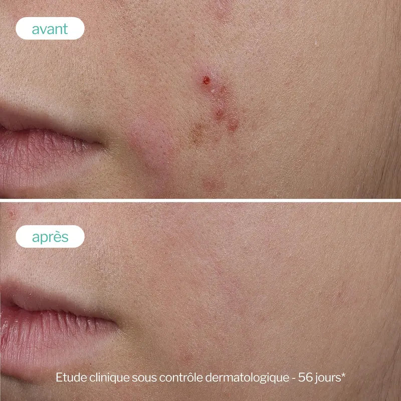 Novexpert Trio-Cink Booster Serum – Serum protiv bubuljica, akni i nepravilnosti