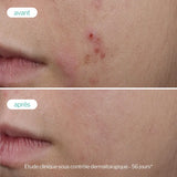 Novexpert Trio-Cink Booster Serum – Serum protiv bubuljica, akni i nepravilnosti